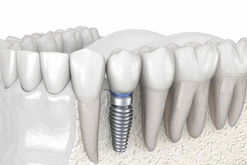 Dental Implants