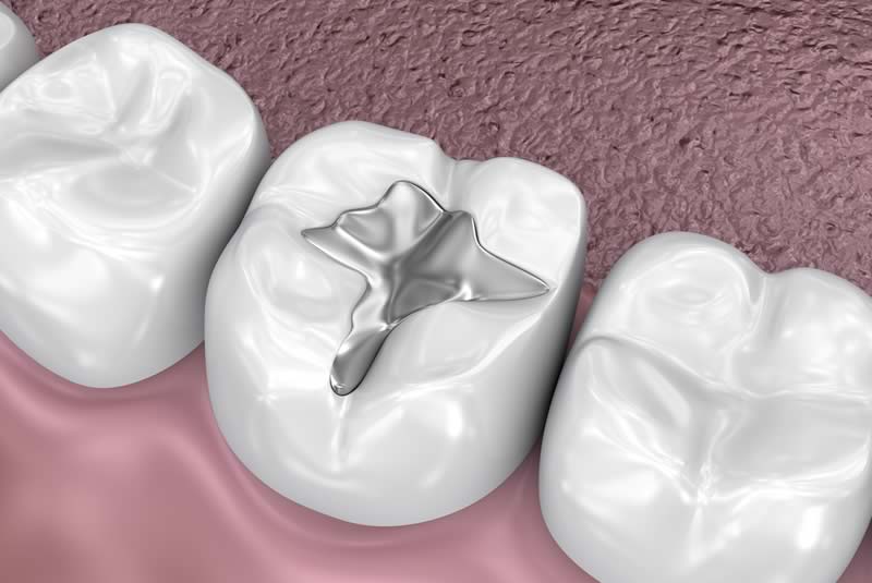 Fillings