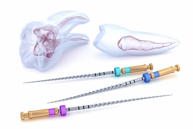 Root Canal